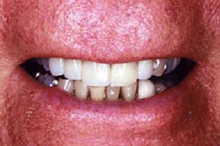 Man's smile with uneven bite