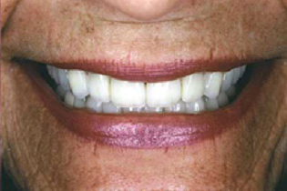 Older woman with all 28 teeth repaired empress veneers and crowns