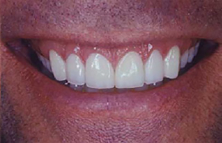Fully transformed smile with six porcelain veneers