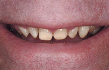Smile with no enamel and misshaped teeth