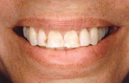 Woman's stained and worn teeth