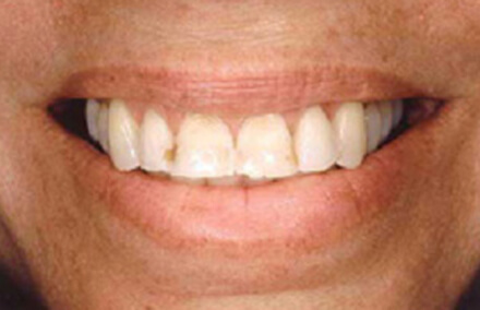 Woman with stained and worn teeth