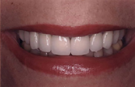 Woman's corrected smile with bright white teeth after porcelain crowns