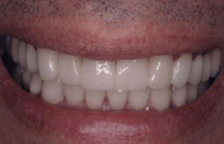 Man's smile corrected with Empress dental crowns