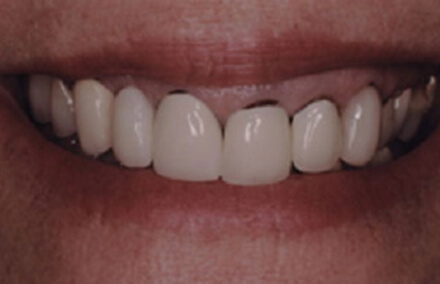 Woman's teeth darkened at the gum line