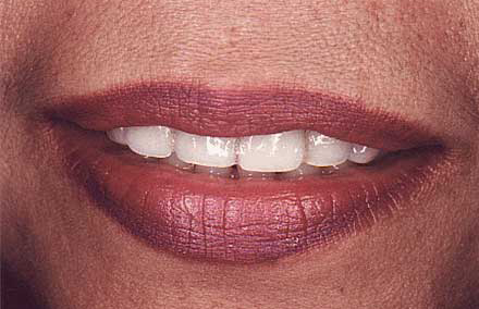 Woman with short discolored teeth