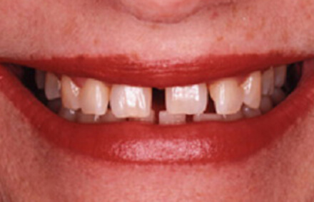 Smile with gaps and damaged teeth