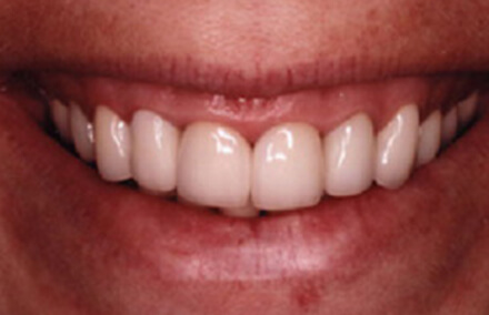 Yellow tooth and discolored smile corrected with crowns and composite dental bonding