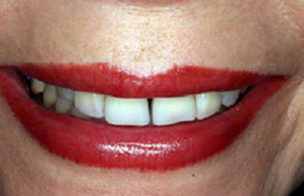 Woman with short front teeth with large gap