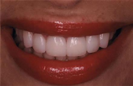 Woman's smile corrected with Empress veneers