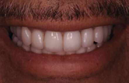 Corrected teeth with Empress dental crowns