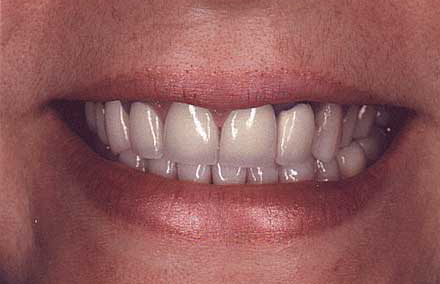 Dental crown with dark ring at top