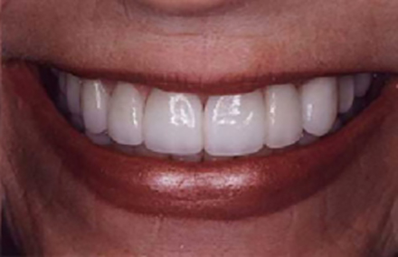 Gap between teeth closed with Empress crowns