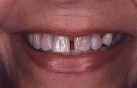 Smile with large gap between front teeth