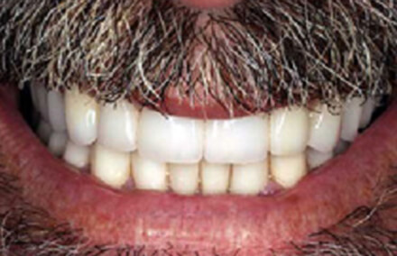 Stained teeth corrected with zirconia crowns