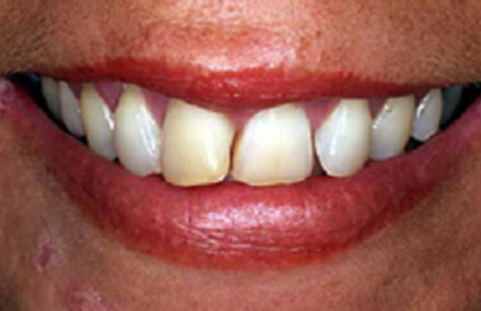 Smile with yellow damaged front tooth