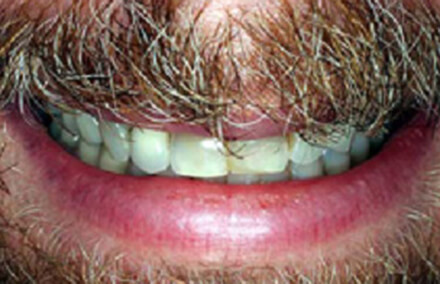 Man's smile with short discolored top teeth