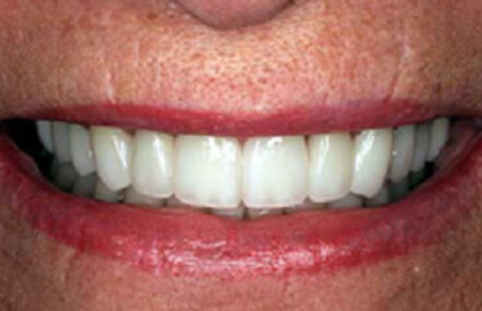 Woman's stained teeth corrected with zirconia and porcelain to gold crowns