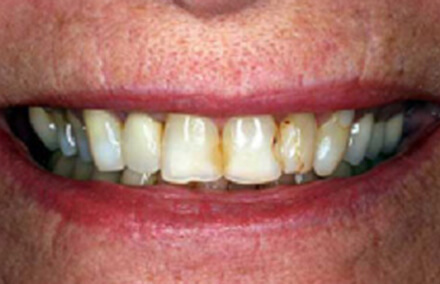 Woman's smile with numerous dark stains