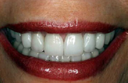 Repaired smile gap with Empress dental crowns