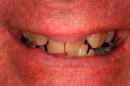 Man with yellowed damaged and crooked teeth