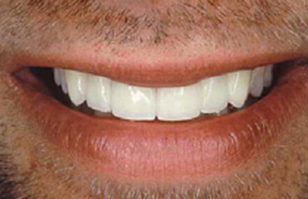 Same man's brilliant white smile after Empress 2 all porcelain fixed bridge