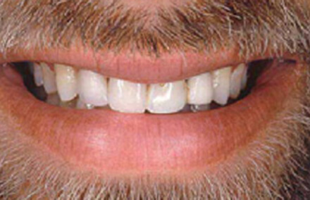 Man's discolored smile with damaged dental bridge