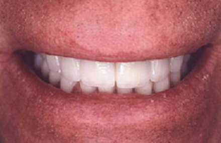 Corrected irregular tooth sizing with eight veneers