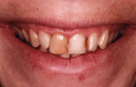 Severely decayed and discolored front teeth