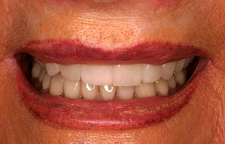 Dark teeth concealed with crowns and veneers