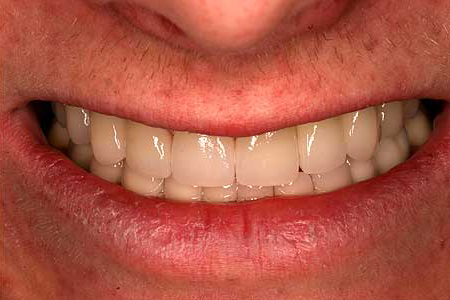 Smile repaired with crowns, veneers, bridges, and dental implants