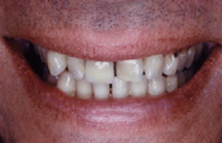 Unevenly spaced stained teeth