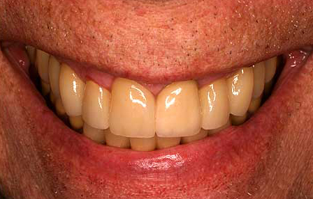 Bite repaired with zirconia crowns and bridges