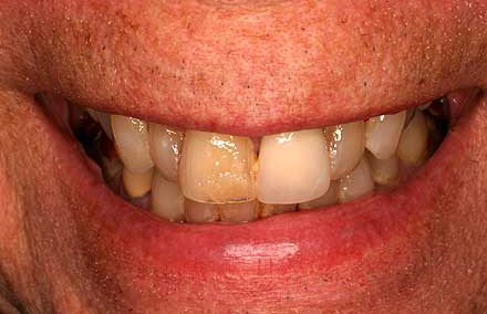 Discolored teeth and poorly fitting bite