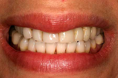 Worn teeth with severe yellowing