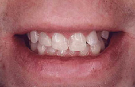 Man with missing tooth following facial trauma
