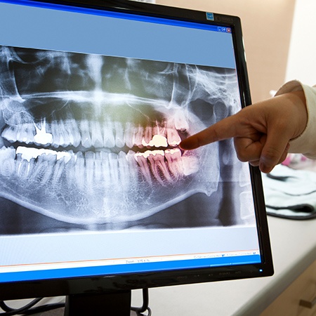 Digital dental x rays on computer screen