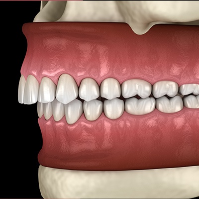 3 D rending of bite in need of occlusal adjustment