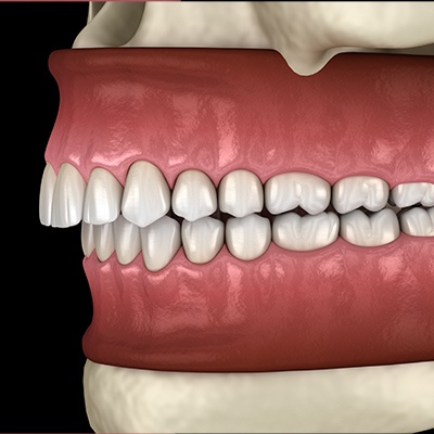 3 D rending of bit in need of occlusal adjustment