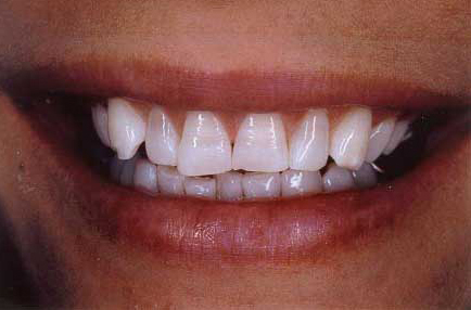 Brightened smile after teeth whitening