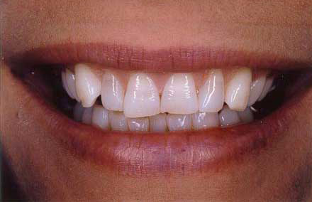 Yellowed teeth in attractive smile