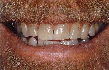 Man's smile with dark yellow teeth
