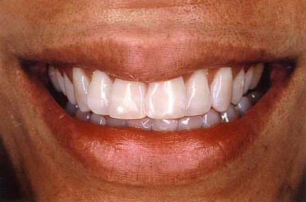 Smile perfected with in-office teeth whitening