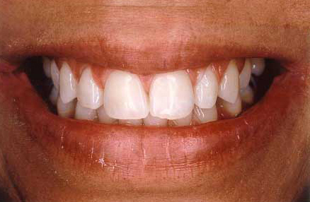 Dramatically brighter smile following teeth whitening