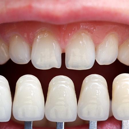 A series of veneers compared to imperfect teeth.