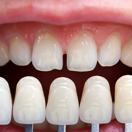 A series of veneers in Rancho Bernardo compared to imperfect teeth