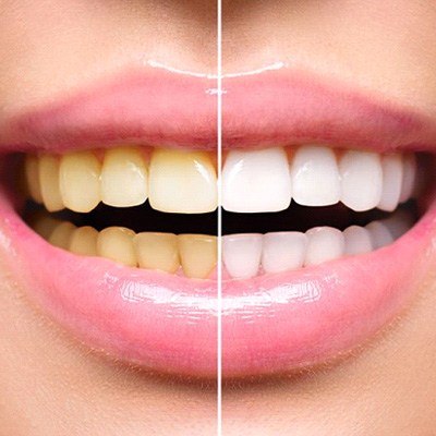 Close up of smile before and after teeth whitening