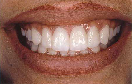 Worn teeth repaired with Empress veneer-crowns