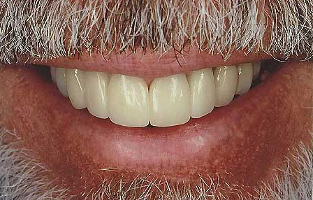 Flawless smile created with Empress veneer-crowns
