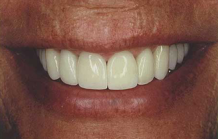 Transformed smile flawlessly crafted with veneers and crowns